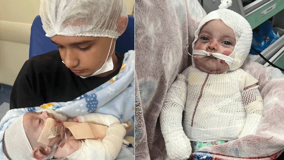 Lohan, bebê de 4 meses com epidermólise bolhosa, internado desde o nascimento